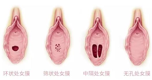 成熟女性阴部（私处）是什么样 健康标准是什么