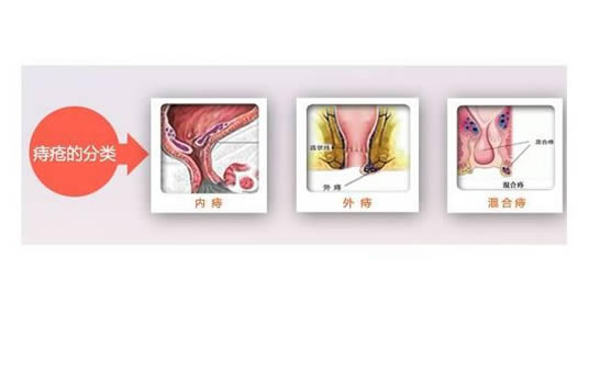 女人痔疮的图片 女性痔疮的症状有哪些
