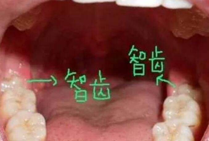 智齿有必要拔吗 什么样的智齿不需要拔