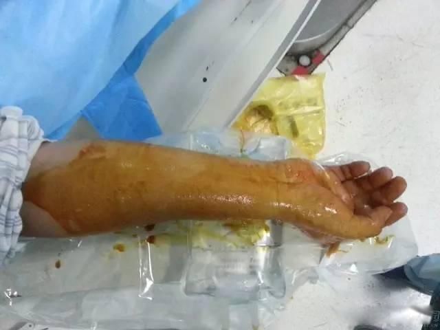 dsa医学上是什么意思 心脏dsa造影是什么检查