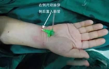 dsa医学上是什么意思 心脏dsa造影是什么检查