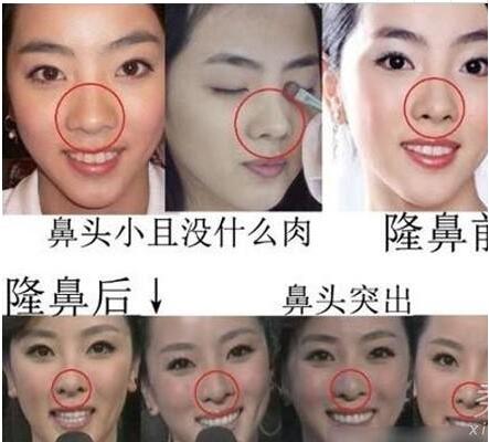 李思思的鼻子怎么是歪的 李思思整容前后对比照片