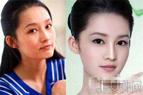 李思思的鼻子怎么是歪的 李思思整容前后对比照片